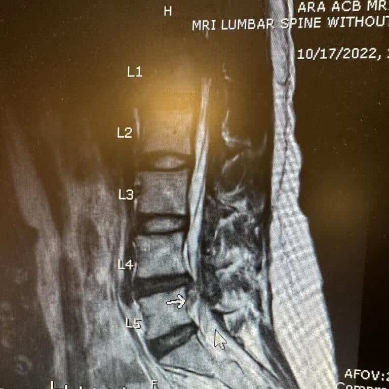 Andrea Liserio | herniated disc MRI